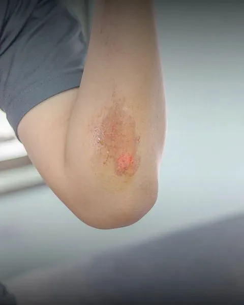 Manejo Avanzado de Heridas